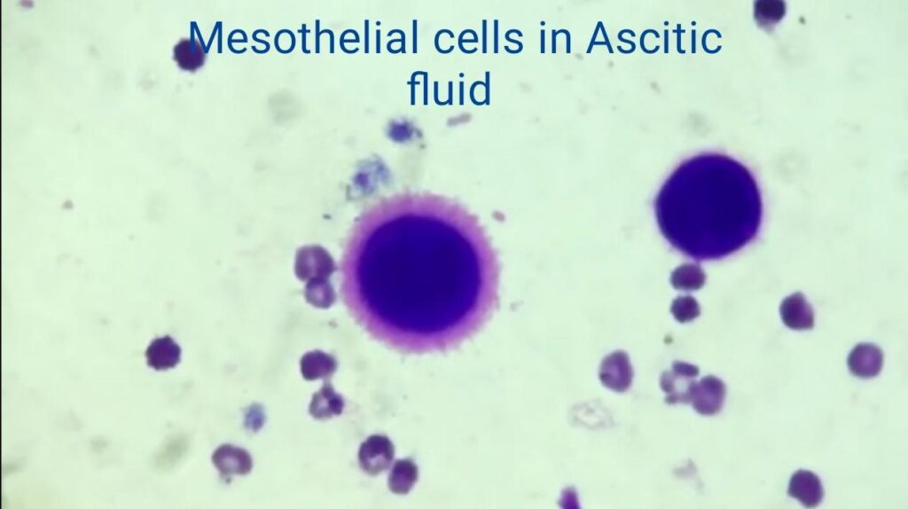 Mesothelial cells, Mesothelium, and Mesothelioma- An explanation